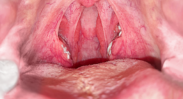 Tratamiento del Absceso periamigdalino en CDMX y Edo. Mex.